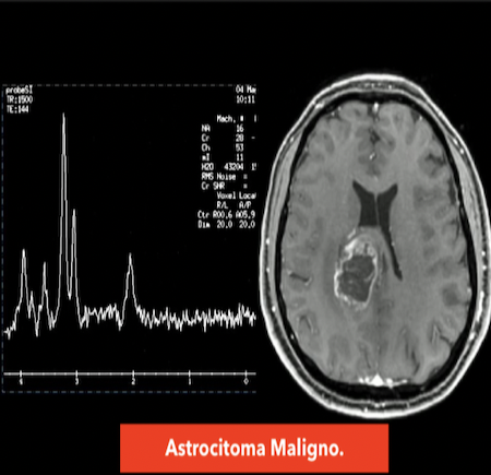 Resonancia y espectroscopía de astrocitoma