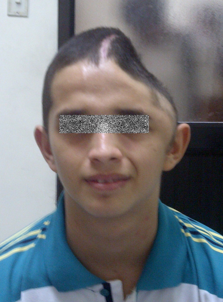 Fotografía de un paciente tras craniectomía descompresiva, con los ojos cubiertos