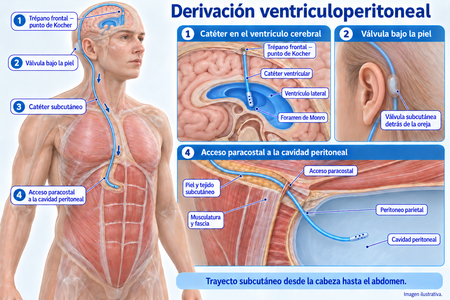 Ilustración de una derivación ventriculoperitoneal: catéter ventricular, válvula detrás de la oreja, trayecto subcutáneo y acceso a la cavidad peritoneal